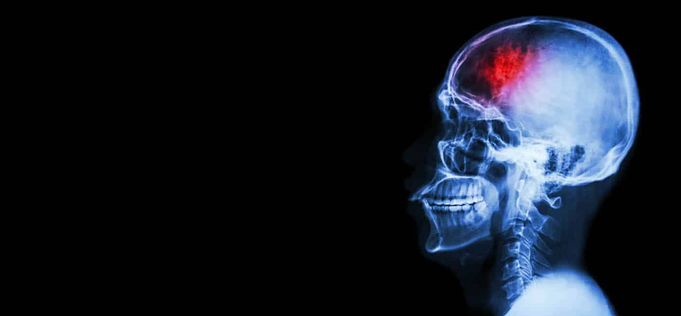 Brain Injury After a DUI Accident