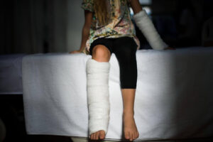 A girl victim of a car accident suffered from broken bones in her leg and arm