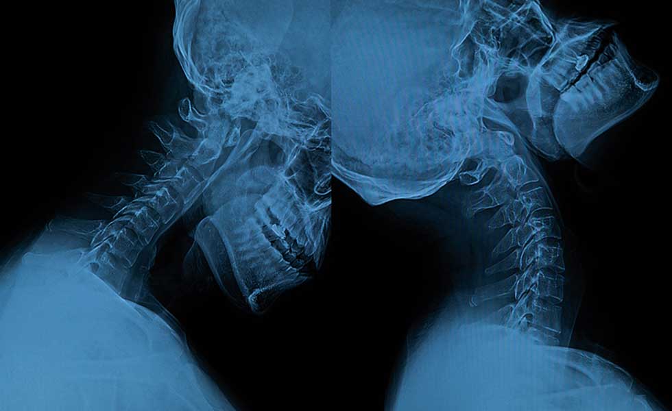 x-ray result | whiplash and knee injury in a car accident